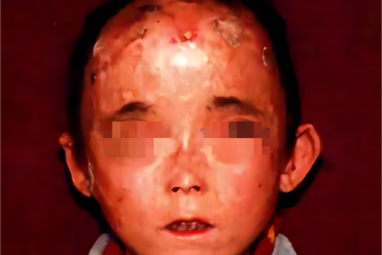 先天性红细胞生成性卟啉病瘢痕图 先天性红细胞生成性卟啉病瘢痕图