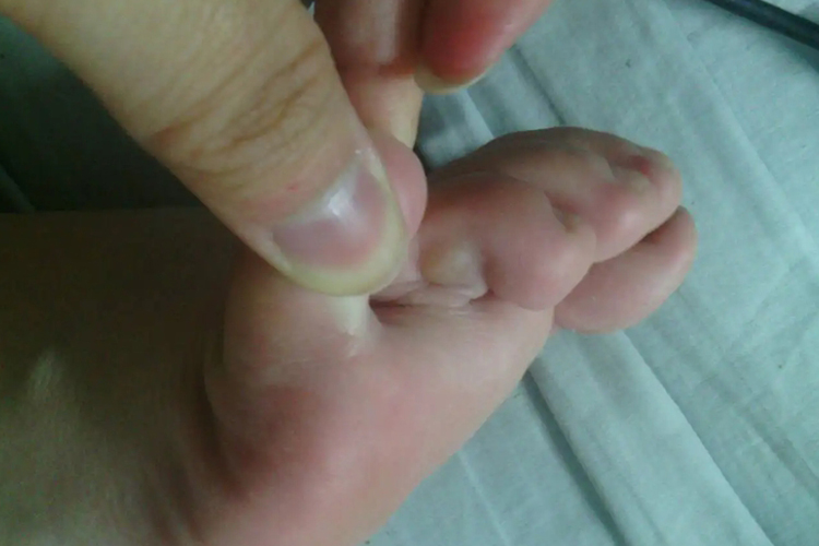 脚趾缝鸡眼图 脚趾缝鸡眼图