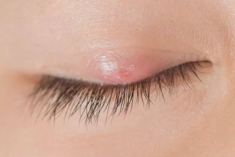 上眼皮睑腺炎图