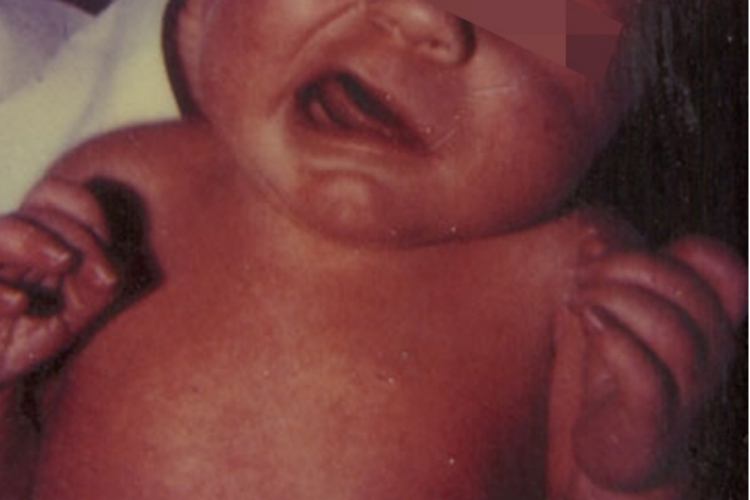 婴儿单纯局灶性发作早期图