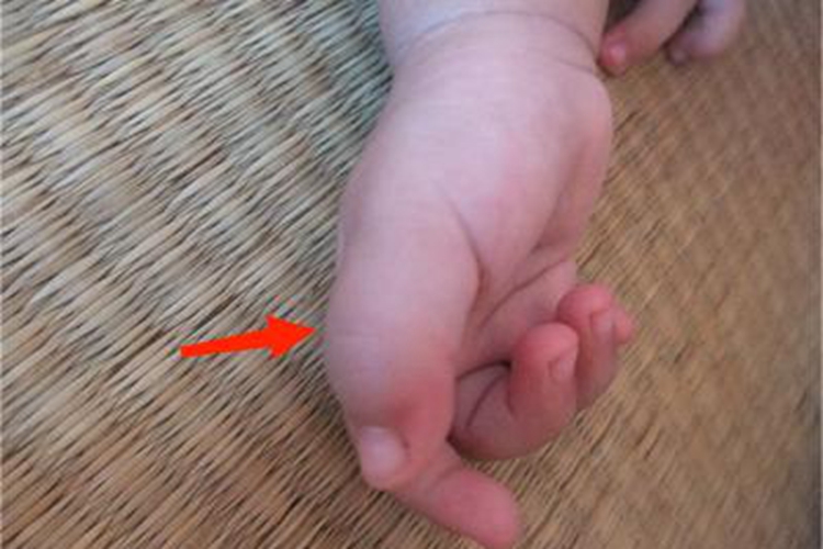 巨指畸形大拇指巨大图