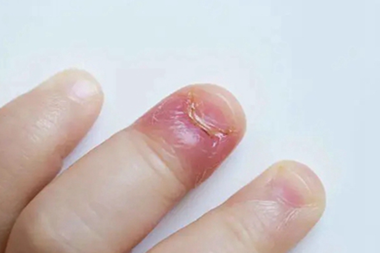 急性甲沟炎红肿图
