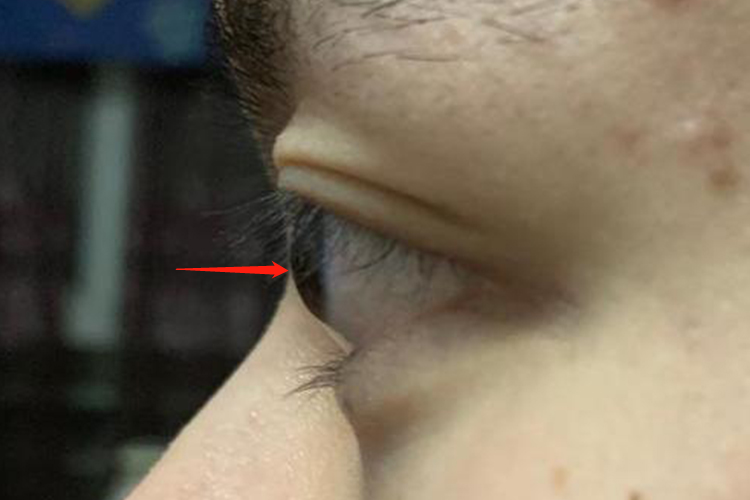 高度近视眼角膜变形图