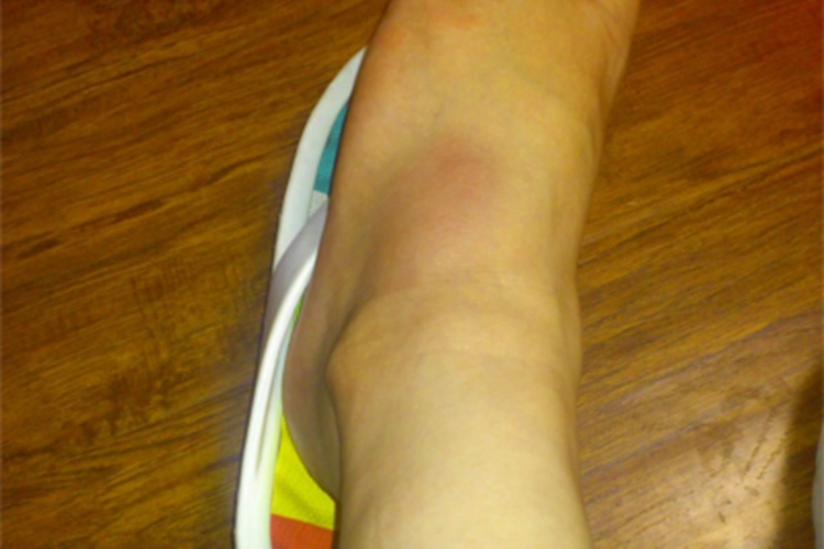 中度扭伤脚踝肿胀发红图