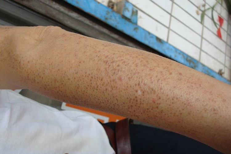 毛周角化症图片