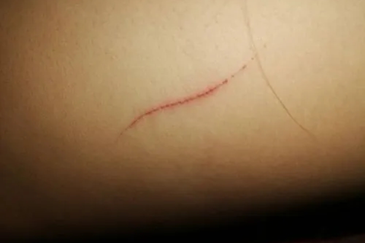 指甲抓痕血痂图