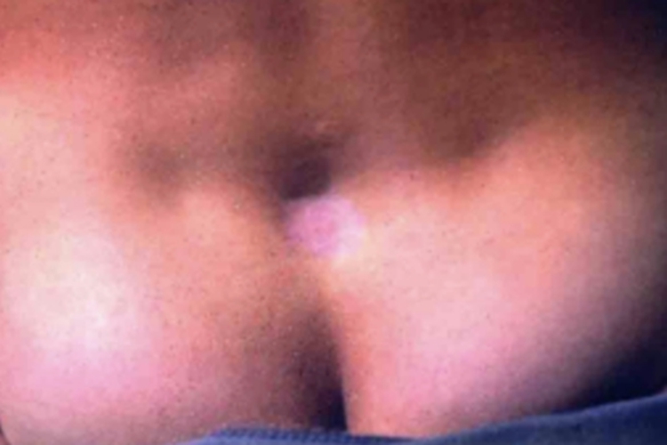 深在性红斑狼疮小坑图