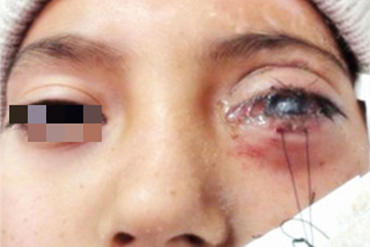 眶蜂窝织炎下眼睑渗液图