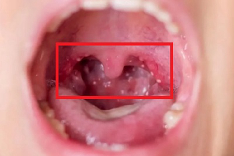 疱疹性咽峡炎咽喉小水疱图 疱疹性咽峡炎咽喉小水疱图