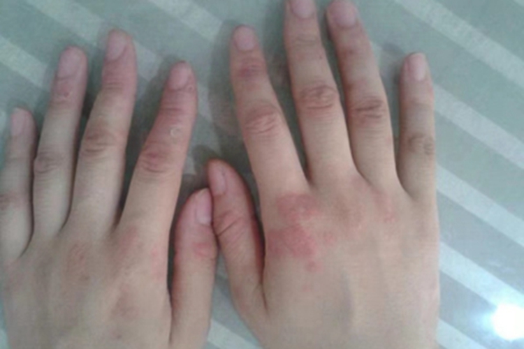 手部湿疹手背有大片红斑图