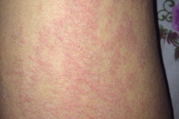 男孩大腿根部慢性湿疹图