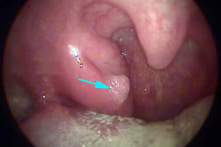 扁桃体乳头状瘤图
