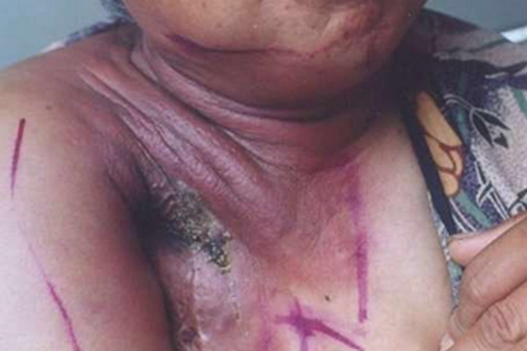 急性放射性皮炎胸部糜烂图 急性放射性皮炎胸部糜烂图