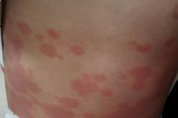 川崎病腰上有红色斑块图