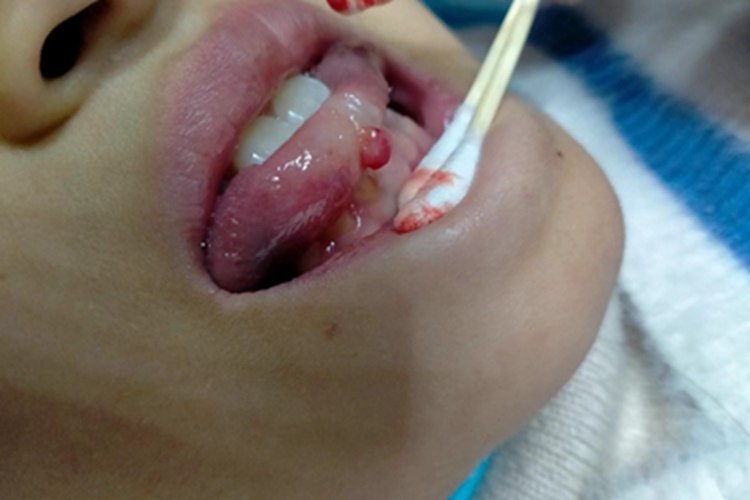 血管瘤舌头症状图