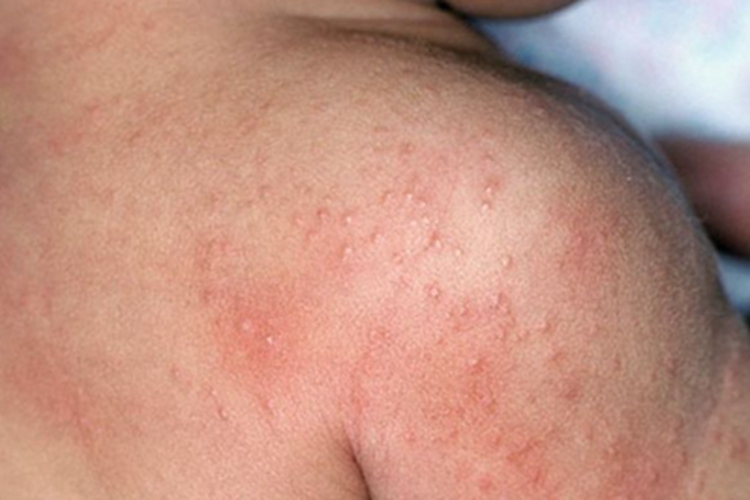 小儿海鲜过敏肩部小水疱图 小儿海鲜过敏肩部小水疱图