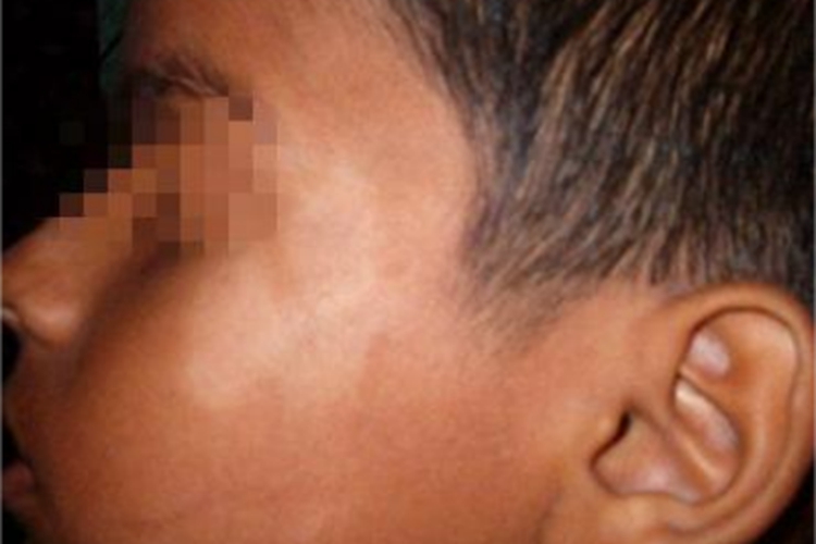 白癜风面部皮肤颜色变浅图