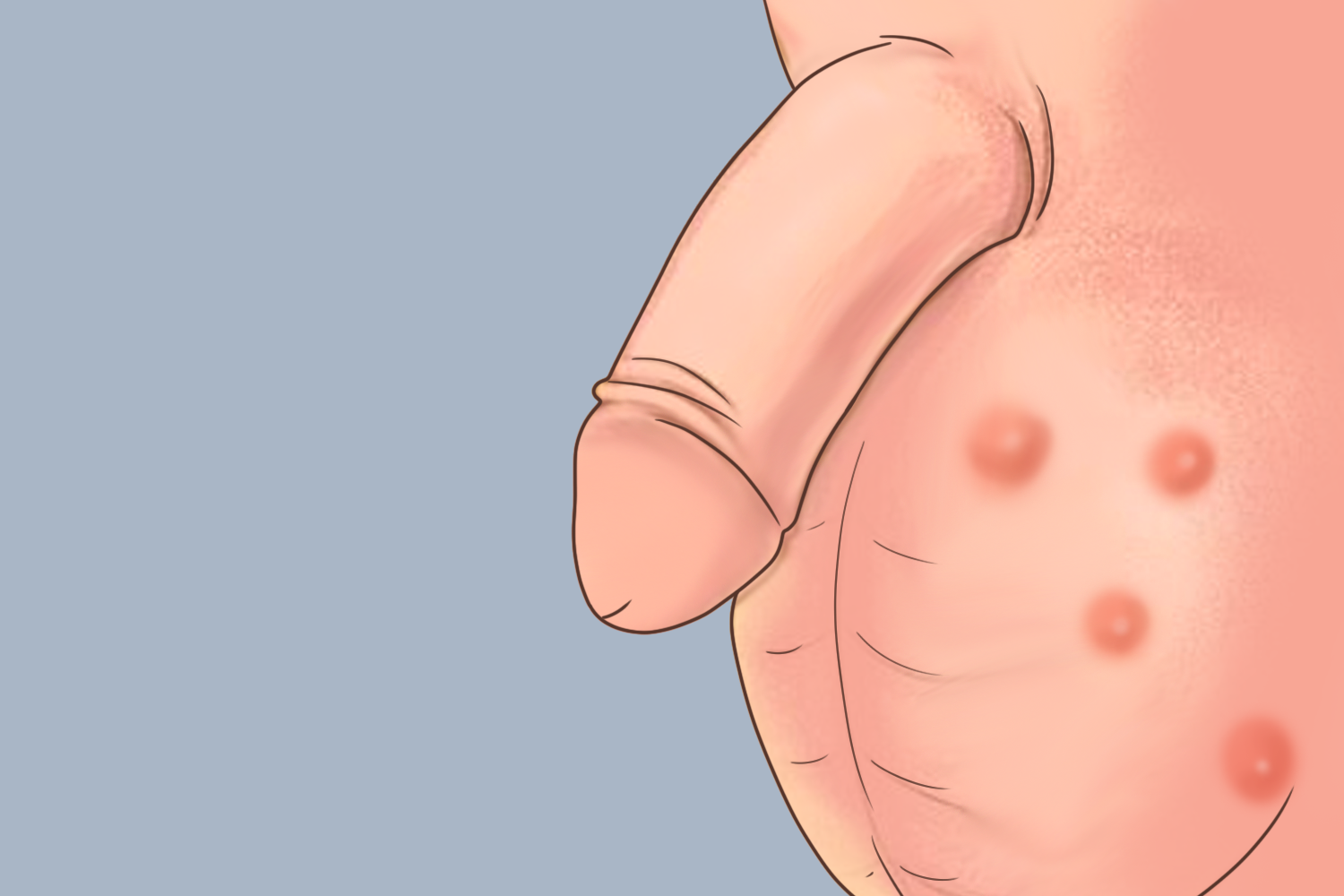 阴虱叮咬疙瘩图