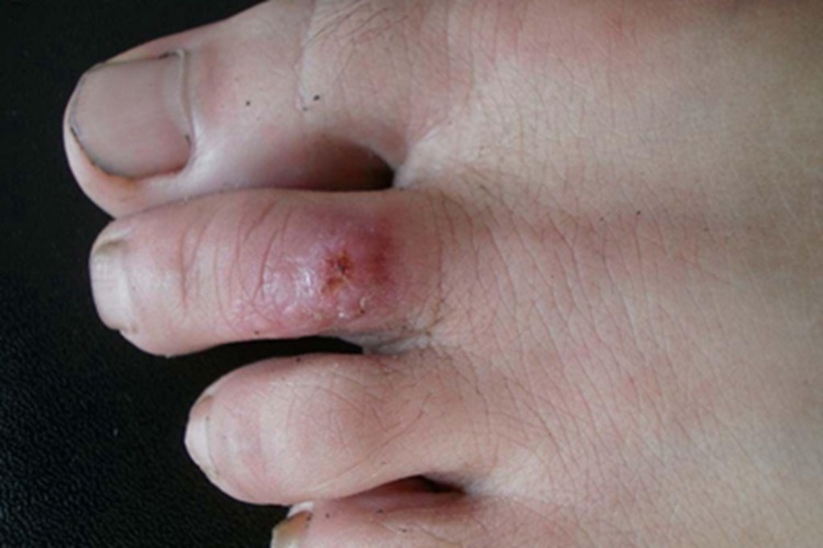 鼻孢子菌病脚趾小疙瘩图