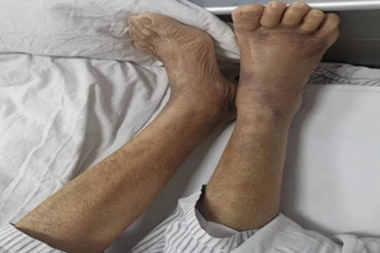 老年性紫癜脚背粗糙有青紫斑图