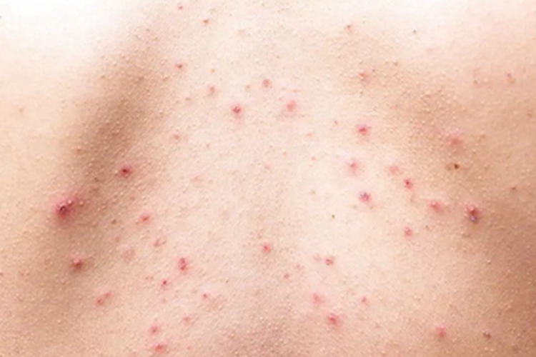 毛囊炎背部小红疙瘩图