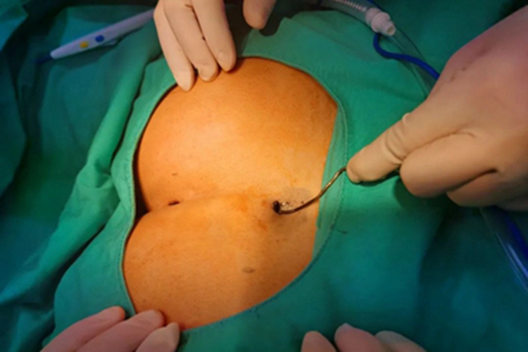 骶尾部藏毛窦出现小孔图