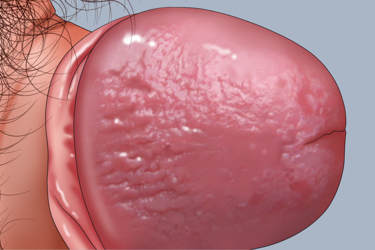 包皮龟头炎包皮淋巴水肿图 包皮龟头炎包皮淋巴水肿图