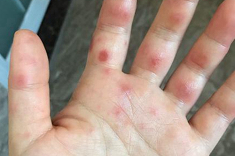 手足综合征红斑图