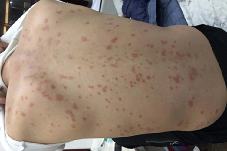 色素性痒疹后背红色的斑点图 色素性痒疹后背红色的斑点图