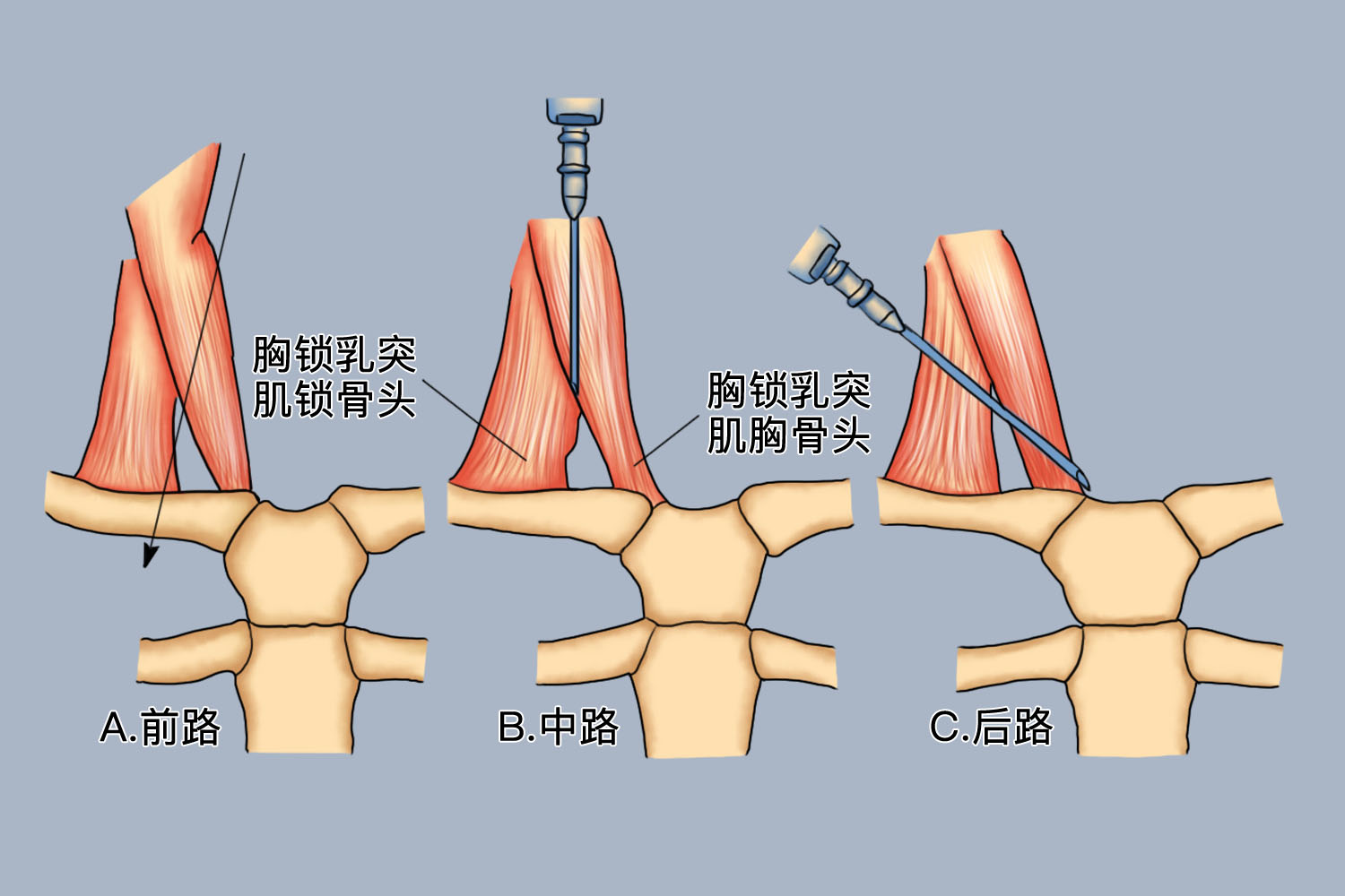 颈内静脉穿刺定位图