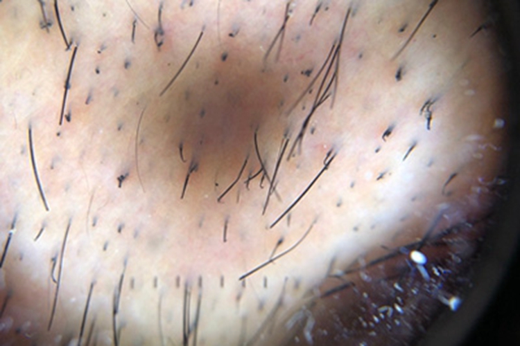 拔毛癖镜下头发残根图