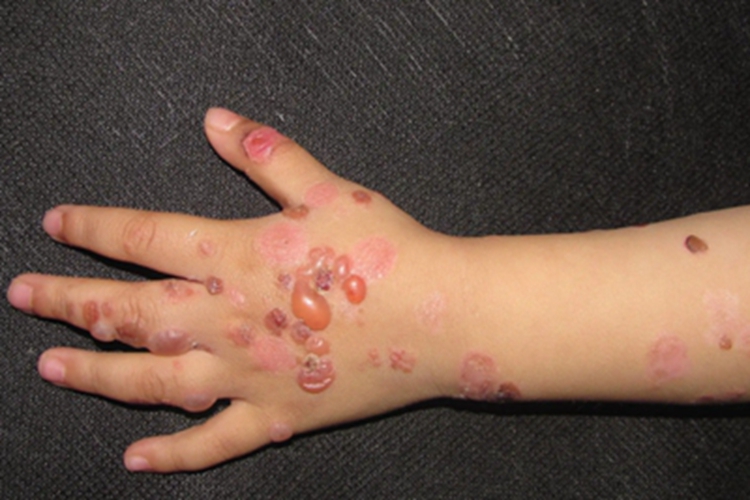 线状IgA大疱性皮肤病手背结痂图 线状IgA大疱性皮肤病手背结痂图
