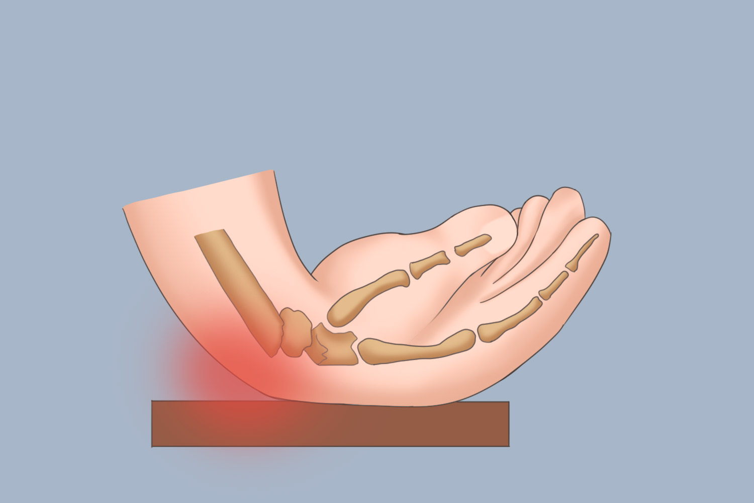 新生儿外力损伤手腕内弯图