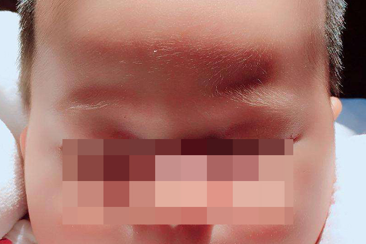 额头突出正常表现图