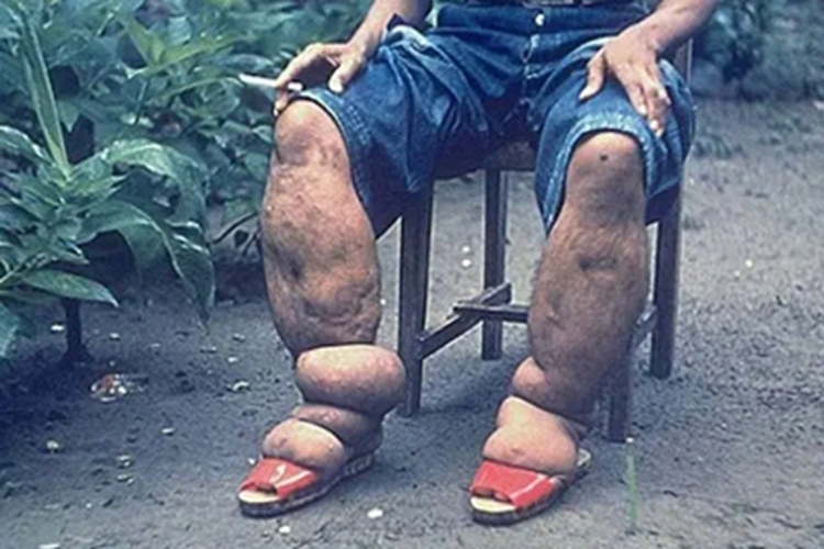 淋巴水肿小腿皮肤发黑图 淋巴水肿小腿皮肤发黑图