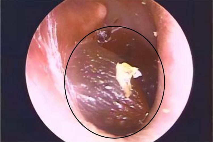 鼓膜炎大疙瘩图