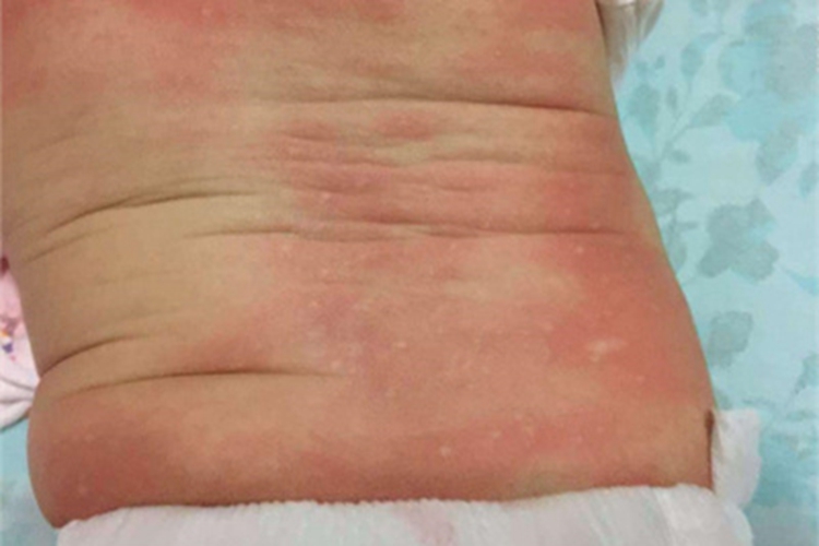 新生儿红斑后背上有红疙瘩图 新生儿红斑后背上有红疙瘩图