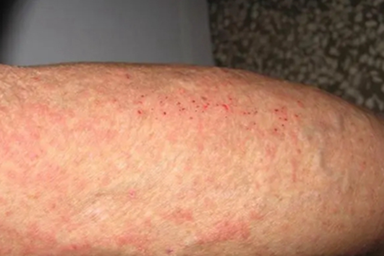 瘙痒症红点图
