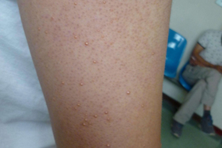 发疹性黄瘤疙瘩图