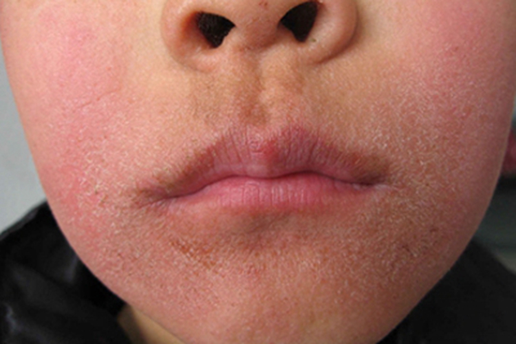 皮肤过敏红肿图 皮肤过敏红肿图