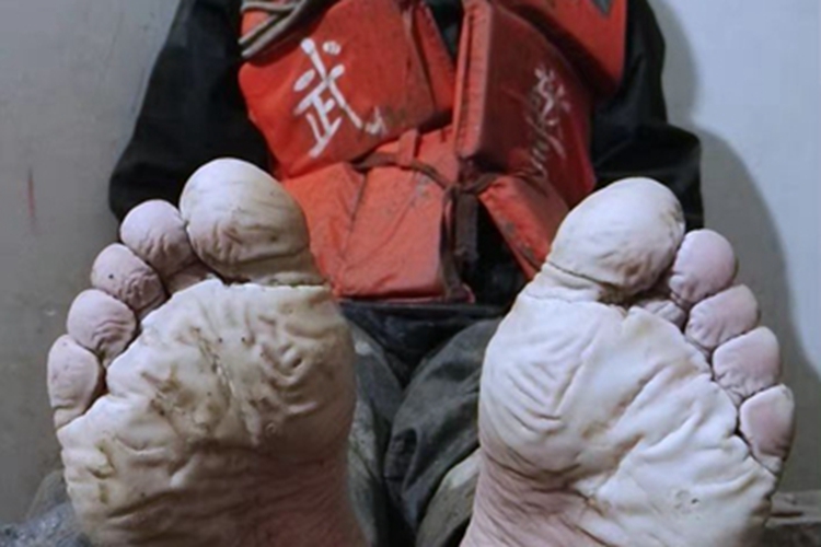 战壕足脚底症状图