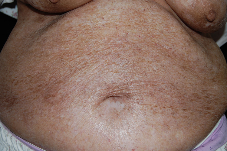 干性湿疹碎瓷样改变图