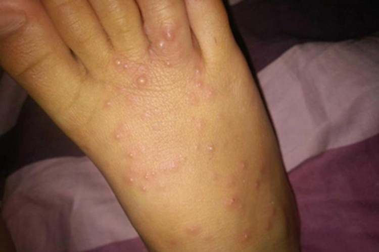 水痘脚背有很多密集小水疱图 水痘脚背有很多密集小水疱图