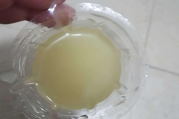 米汤样尿图 米汤样尿图