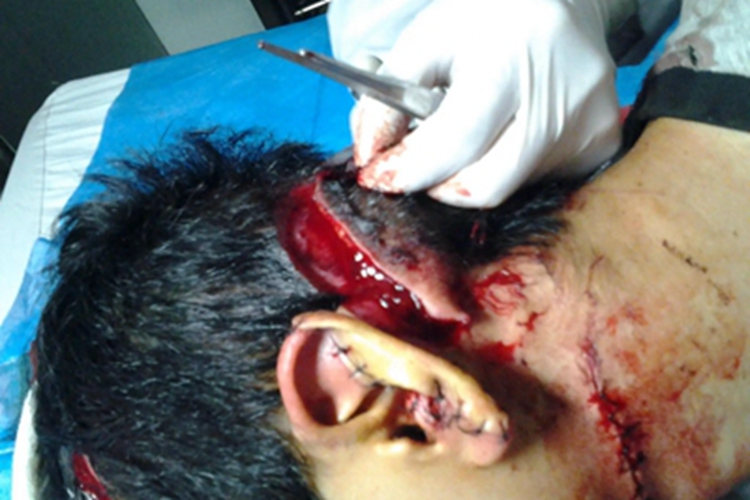 开放性颅脑损伤症状图