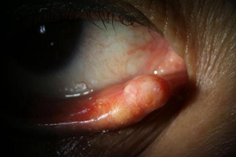 皮脂腺瘤眼睑小疙瘩图