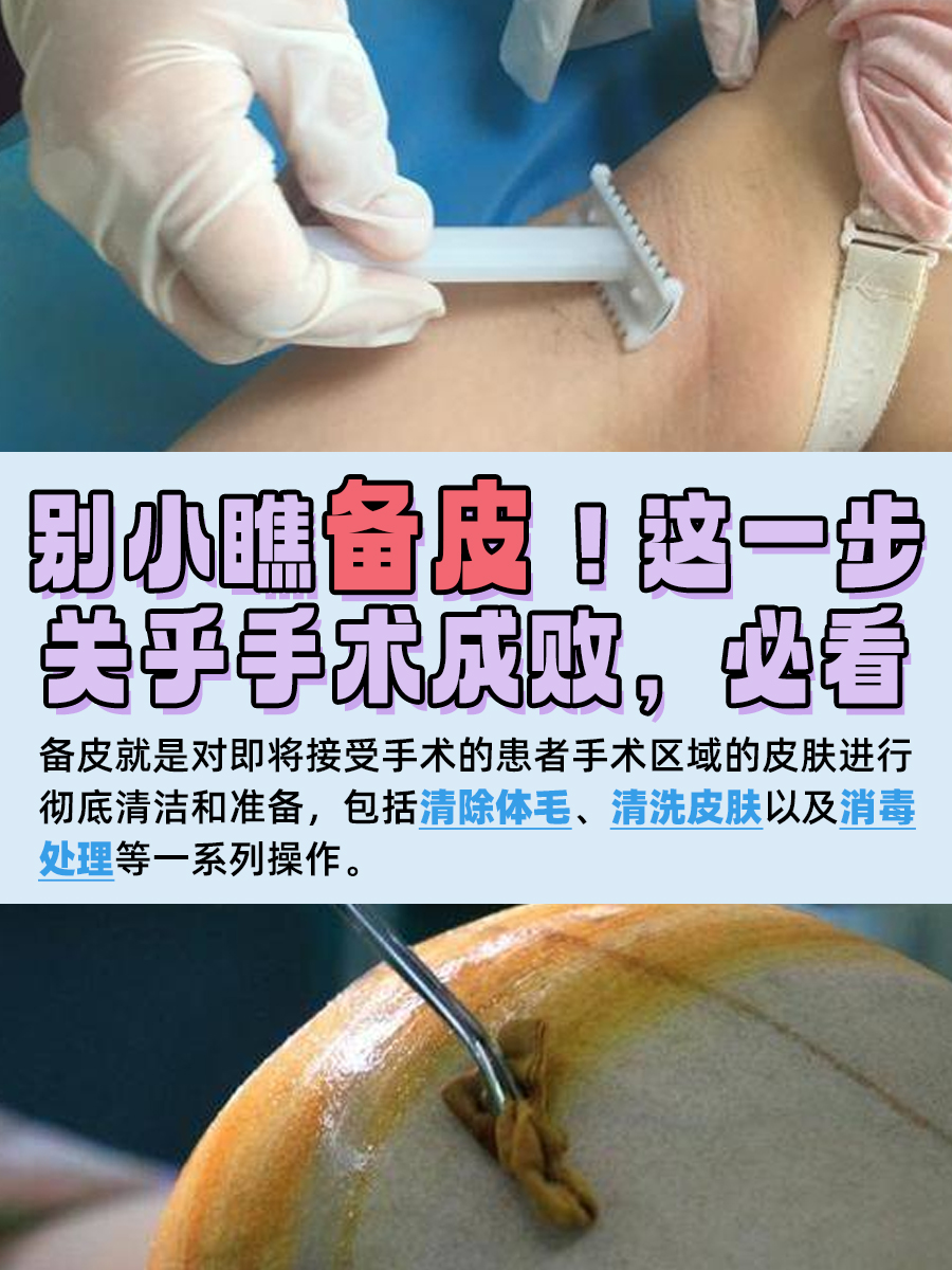 别小瞧备皮！这一步关乎手术成败，必看