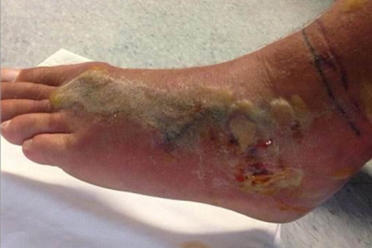 蛇咬伤脚背症状图