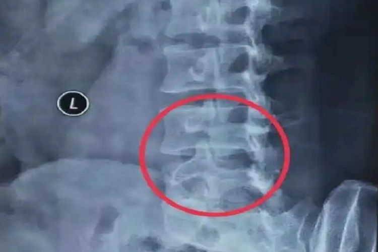 腰椎狗头征图 腰椎狗头征图