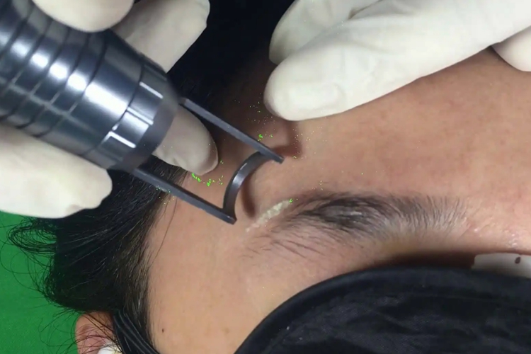 激光洗眉术中图